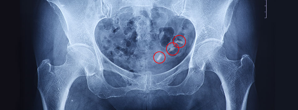 VitaminXRay2